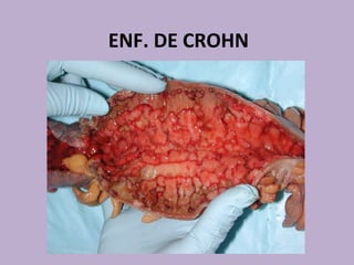 ENF. DE CROHN

 