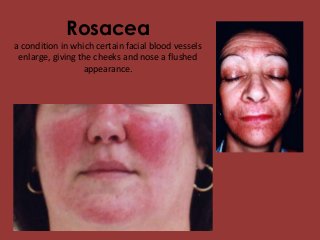 Rosacea
a condition in which certain facial blood vessels
enlarge, giving the cheeks and nose a flushed
appearance.
 