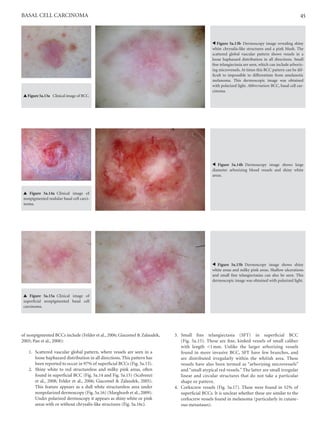 Aborizing Pattern An Atlas of Dermoscopy, Second Edition ( PDFDrive ).pdf