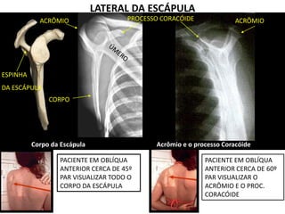 LATERAL DA ESCÁPULA
Acrômio e o processo CoracóideCorpo da Escápula
CORPO
ACRÔMIO PROCESSO CORACÓIDE ACRÔMIO
ESPINHA
DA ESCÁPULA
PACIENTE EM OBLÍQUA
ANTERIOR CERCA DE 45º
PAR VISUALIZAR TODO O
CORPO DA ESCÁPULA
PACIENTE EM OBLÍQUA
ANTERIOR CERCA DE 60º
PAR VISUALIZAR O
ACRÔMIO E O PROC.
CORACÓIDE
 