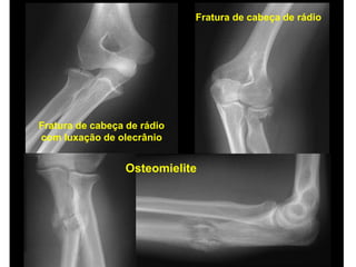 Fratura de cabeça de rádio
com luxação de olecrânio
Fratura de cabeça de rádio
Osteomielite
 