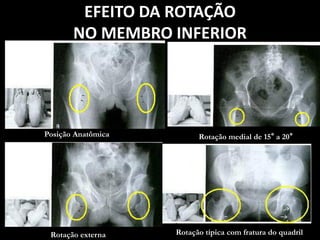EFEITO DA ROTAÇÃO
NO MEMBRO INFERIOR
Posição Anatômica Rotação medial de 15° a 20°
Rotação externa Rotação típica com fratura do quadril
 