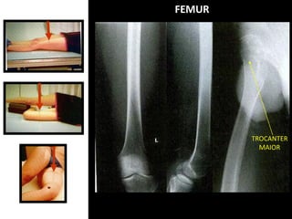FEMUR
TROCANTER
MAIOR
 