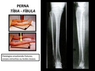 PERNA
TÍBIA - FÍBULA
Patologias envolvendo fraturas,
corpos estranhos ou lesões ósseas.
 