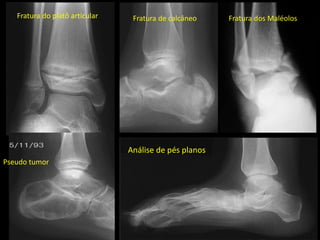 Análise de pés planos
Fratura do platô articular Fratura de calcâneo
Pseudo tumor
Fratura dos Maléolos
 