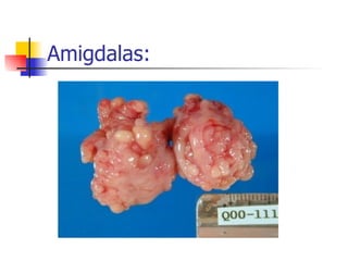Amigdalas: 