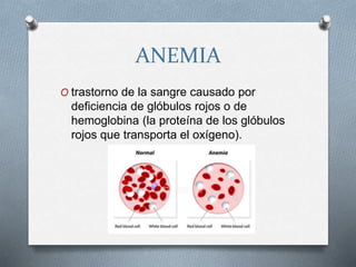 ANEMIA
O trastorno de la sangre causado por
deficiencia de glóbulos rojos o de
hemoglobina (la proteína de los glóbulos
rojos que transporta el oxígeno).
 
