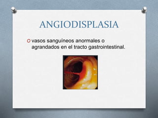 ANGIODISPLASIA
O vasos sanguíneos anormales o
agrandados en el tracto gastrointestinal.
 