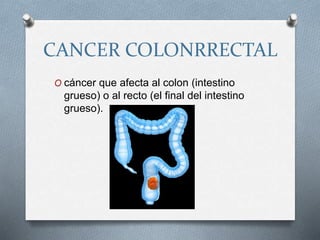 CANCER COLONRRECTAL
O cáncer que afecta al colon (intestino
grueso) o al recto (el final del intestino
grueso).
 