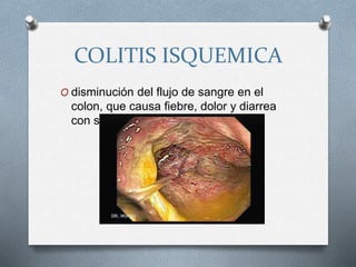 COLITIS ISQUEMICA
O disminución del flujo de sangre en el
colon, que causa fiebre, dolor y diarrea
con sangre.
 
