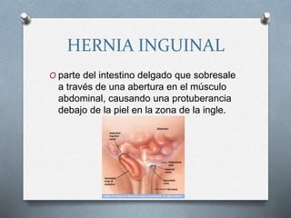 HERNIA INGUINAL
O parte del intestino delgado que sobresale
a través de una abertura en el músculo
abdominal, causando una protuberancia
debajo de la piel en la zona de la ingle.
 