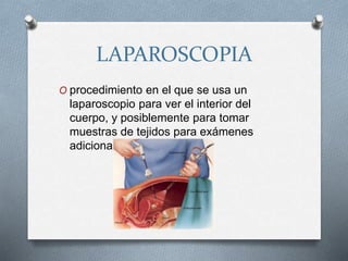 LAPAROSCOPIA
O procedimiento en el que se usa un
laparoscopio para ver el interior del
cuerpo, y posiblemente para tomar
muestras de tejidos para exámenes
adicionales.
 