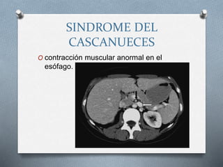 SINDROME DEL
CASCANUECES
O contracción muscular anormal en el
esófago.
 