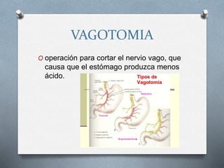 VAGOTOMIA
O operación para cortar el nervio vago, que
causa que el estómago produzca menos
ácido.
 