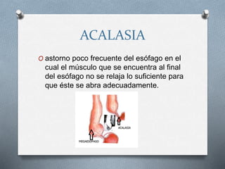 ACALASIA
O astorno poco frecuente del esófago en el
cual el músculo que se encuentra al final
del esófago no se relaja lo suficiente para
que éste se abra adecuadamente.
 