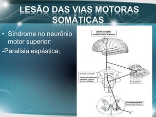 LESÃO DAS VIAS MOTORAS
SOMÁTICAS
• Síndrome do neurônio motor inferior
(paralisia infantil) :
-Paralisia flácida;
 