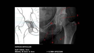 ESPACIO ARTICULAR
SUP Y AXIAL: 4mm
MEDIAL: M: 8mm H: 9mm > 1,5 MM= AFECCION
 