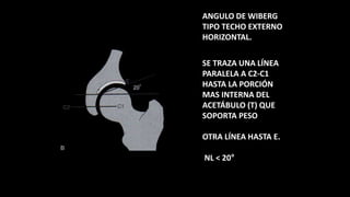 ANGULO DE WIBERG
TIPO TECHO EXTERNO
HORIZONTAL.
SE TRAZA UNA LÍNEA
PARALELA A C2-C1
HASTA LA PORCIÓN
MAS INTERNA DEL
ACETÁBULO (T) QUE
SOPORTA PESO
OTRA LÍNEA HASTA E.
NL < 20°
 