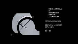 ÍNDICE ACETABULAR
DE
PROFUNDIDAD
RESPECTO
A LA ANCHURA.
SE TRAZAN DOS LÍNEAS.
SE CALCULA LA RELACIÓN
(D/W) X 100.
NL > 38
 