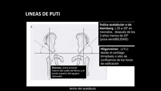 EVALUA
EVAL
LINEAS DE PUTI
Índice acetabular o de
kleinberg, ( 25 a 30º en
neonatos, después de los
3 años menos de 20º
(poca sensIBILIDAD)
Hilgenreiner, («Y»)
desde el cartílago
trirradiado o sitio de
confluencia de los focos
de osificación
Perkin, desde el borde
osificado más lateral del
techo del acetábulo
Shenton, entre el borde
interno del cuello del fémur y el
borde superior del agujero
obturador
 