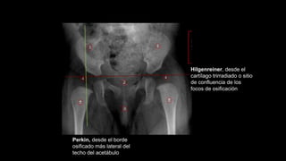 Hilgenreiner, desde el
cartílago trirradiado o sitio
de confluencia de los
focos de osificación
Perkin, desde el borde
osificado más lateral del
techo del acetábulo
 