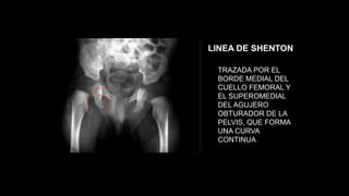 LINEA DE SHENTON
TRAZADA POR EL
BORDE MEDIAL DEL
CUELLO FEMORAL Y
EL SUPEROMEDIAL
DEL AGUJERO
OBTURADOR DE LA
PELVIS, QUE FORMA
UNA CURVA
CONTINUA
 