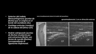 • Anterior del rodete
fibrocartilaginoso (puntas de
flecha) que se origina en el
borde del acetábulo (Ac).
• Cartílago articular (rombos)
de la cabeza del fémur (CF).
• Rodete adelgazado (puntas
de flecha) recubierto por
una estructura fibrilar con
forma de cuerda (flechas)
correspondiente al
ligamento iliofemoral.
zona inmediatamente lateral al tendón del psoasilíaco
aproximadamente 1 cm en dirección externa
 