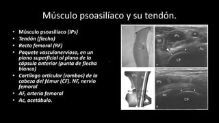 Músculo psoasilíaco y su tendón.
• Músculo psoasilíaco (IPs)
• Tendón (flecha)
• Recto femoral (RF)
• Paquete vasculonervioso, en un
plano superficial al plano de la
cápsula anterior (punta de flecha
blanca)
• Cartílago articular (rombos) de la
cabeza del fémur (CF). NF, nervio
femoral
• AF, arteria femoral
• Ac, acetábulo.
 