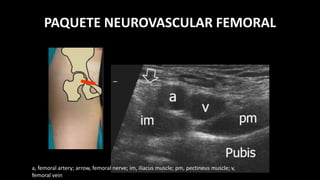 PAQUETE NEUROVASCULAR FEMORAL
a, femoral artery; arrow, femoral nerve; im, iliacus muscle; pm, pectineus muscle; v,
femoral vein
 