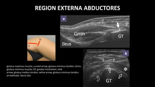 REGION EXTERNA ABDUCTORES
gluteus maximus muscle; curved arrow, gluteus minimus tendon; Gmin,
gluteus minimus muscle; GT, greater trochanter; void
arrow, gluteus medius tendon; white arrow, gluteus minimus tendon;
arrowheads, fascia lata
 