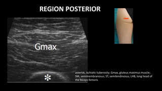 REGION POSTERIOR
asterisk, ischiatic tuberosity; Gmax, gluteus maximus muscle;
SM, semimembranosus; ST, semitendinosus; LHB, long head of
the biceps femoris
 