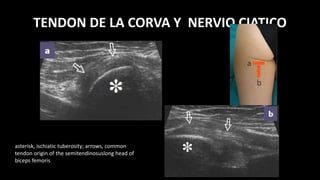 TENDON DE LA CORVA Y NERVIO CIATICO
asterisk, ischiatic tuberosity; arrows, common
tendon origin of the semitendinosuslong head of
biceps femoris
 