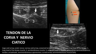 TENDON DE LA
CORVA Y NERVIO
CIATICO
large void arrow, sciatic nerve; narrow void arrow, conjoined tendon of the semitendinosus-long head of the biceps; 1,
long-head of the biceps muscle; 2, semitendinosus muscle; 3, adductor magnus muscle; white arrow, semimembranosus
tendon; arrowheads, semimembranosus aponeurosis; curved arrow, semimembranosus muscle belly
 