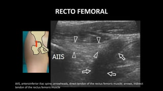 RECTO FEMORAL
AIIS, anteroinferior iliac spine; arrowheads, direct tendon of the rectus femoris muscle; arrows, indirect
tendon of the rectus femoris muscle
 