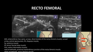 RECTO FEMORAL
AIIS, anteroinferior iliac spine; arrows, direct tendon of the rectus femoris muscle; curved
arrow, central aponeurosis; IPs, iliopsoas muscle;
Sa, sartorius muscle
tfl, tensor fasciae latae muscle
Vint, vastus intermedius muscle;
void arrowheads, proximal myotendinous junction of the rectus femoris muscle
 