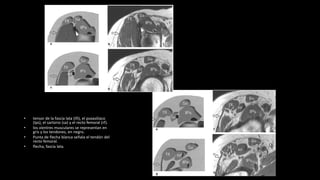 • tensor de la fascia lata (tfi), el psoasilíaco
(Ips), el sartorio (sa) y el recto femoral (rf).
• los vientres musculares se representan en
gris y los tendones, en negro.
• Punta de flecha blanca señala el tendón del
recto femoral.
• flecha, fascia lata.
 