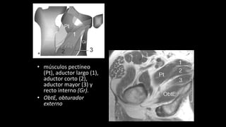 • músculos pectíneo
(Pt), aductor largo (1),
aductor corto (2),
aductor mayor (3) y
recto interno (Gr).
• ObtE, obturador
externo
 