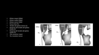 • Glúteo mayor (GMa)
• Glúteo medio (GMe)
• Glúteo menor (GMi)
• Fascia lata (FL)
• Tendón del glúteo menor (1)
• Aanterior del tendón del glúteo
medio (2)
• Posterior del tendón del glúteo
medio (3)
• TM, trocánter mayor
• Tm, trocánter menor.
 