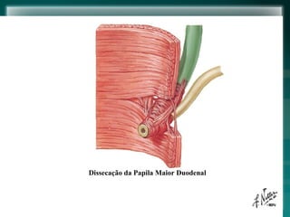 Dissecação da Papila Maior Duodenal 
