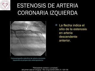 ESTENOSIS DE ARTERIA CORONARIA IZQUIERDA Coronariografía selectiva de arteria coronaria izquierda en proyección anteroposterior La flecha indica el sitio de la estenosis en arteria descendente anterior . “ Retrasplante cardíaco: a propósito  del primer caso en Uruguay”  Rev Urug Cardiol 2006; 21: 124-130  