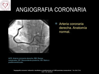 ANGIOGRAFIA CORONARIA ACD: Arteria coronaria derecha; RM: Ramas marginales; DP: Descendente posterior; RV: Retro o posteroventricular. Arteria coronaria derecha. Anatomía normal.  “ Angiografía coronaria: indicación, resultados y complicaciones en 5.000 pacientes consecutivos ”,  Rev Méd Chile 2007; 135: 829-838 