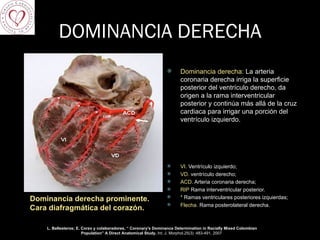 DOMINANCIA DERECHA Dominancia derecha prominente. Cara diafragmática del corazón.  Dominancia derecha:  La arteria coronaria derecha irriga la superficie posterior del ventrículo derecho, da origen a la rama interventricular posterior y continúa más allá de la cruz cardiaca para irrigar una porción del ventrículo izquierdo. VI.  Ventrículo izquierdo;  VD.  ventrículo derecho;  ACD.  Arteria coronaria derecha;  RIP  Rama interventricular posterior.  *  Ramas ventriculares posteriores izquierdas; Flecha.  Rama posterolateral derecha. L. Ballesteros; E. Corzo y colaboradores, “  Coronary's Dominance Determination in Racially Mixed Colombian Population” A Direct Anatomical Study,  Int. J. Morphol.25(3) :483-491, 2007     