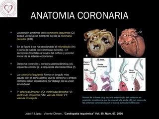 ANATOMIA CORONARIA Visión de la base (a) y la cara anterior (b) del corazón en posición anatómica que se muestra la aorta (A) y el curso de las arterias coronarias por el surco auriculoventricular.  La porción proximal de la  coronaria izquierda  (CI) posee un trayecto diferente del de la  coronaria derecha ( CD).  En la figura b se ha seccionado el i nfundíbulo  (In) o cono de salida del ventrículo derecho. c-f: secciones frontales a través del orificio y porción inicial de la arterias coronarias:  Derecha control (c), derecha aterosclerótica (d), izquierda control (e) e izquierda aterosclerótica (f). La  coronaria izquierda  forma un ángulo más agudo con el seno aórtico que la derecha y ambos orificios están localizados por debajo de la unión sinutubular.  P:  arteria pulmonar ; VD:  ventrículo derecho ; VI:  ventrículo izquierdo ; VM:  válvula mitral ; VT:  válvula tricúspide.  José R López,  Vicente Climen , “ Cardiopatía isquémica” Vol. 59, Núm. 07, 2006     