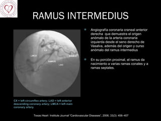 RAMUS INTERMEDIUS CX = left circumflex artery; LAD = left anterior descending coronary artery; LMCA = left main coronary artery. Angiografía coronaria craneal anterior derecha  que demuestra el origen anómalo de la arteria coronaria izquierda desde el seno derecho de Vasalva, además del origen y curso anómalo del ramus intermedius En su porción proximal, el ramus da nacimiento a varias ramas conales y a ramas septales. Texas Heart  Institute Journal “Cardiovascular Diseases”, 2006; 33(3): 406–407  