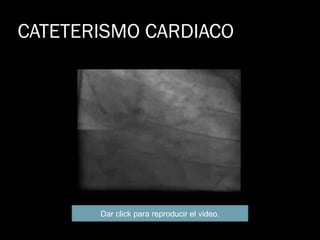 CATETERISMO CARDIACO Dar click para reproducir el video. 