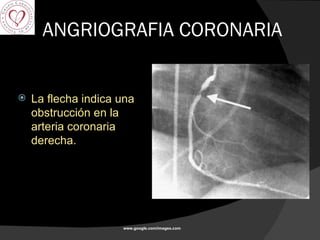 ANGRIOGRAFIA CORONARIA La flecha indica una obstrucción en la arteria coronaria derecha. www.google.com/images.com 