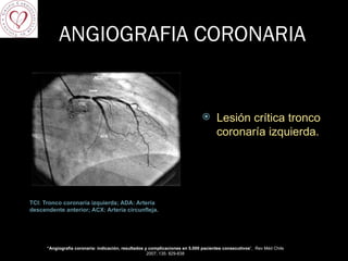 ANGIOGRAFIA CORONARIA TCI: Tronco coronaría izquierda; ADA: Artería descendente anterior; ACX: Artería circunfleja. Lesión crítica tronco coronaría izquierda. “ Angiografía coronaria: indicación, resultados y complicaciones en 5.000 pacientes consecutivos ”,  Rev Méd Chile 2007; 135: 829-838 