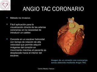 ANGIO TAC CORONARIO Imagen de un corazón con coronarias sanas obtenida mediante Angio TAC Método no invasivo. Fácil aplicación para la visualización directa de las arterias coronarias sin la necesidad de introducir un catéter. Consiste en un escáner helicoidal con tiempo de rotación de alta velocidad que permite adquirir imágenes del corazón en movimiento mientras el paciente es desplazado hacia el interior del escáner. Centro Medico Teknon 