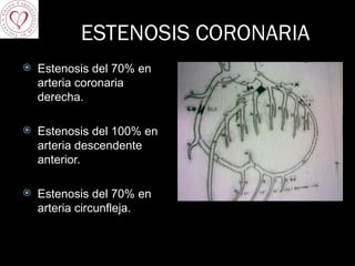 ESTENOSIS CORONARIA Estenosis del 70% en arteria coronaria derecha. Estenosis del 100% en arteria descendente anterior. Estenosis del 70% en arteria circunfleja.  