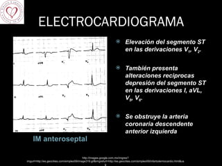 ELECTROCARDIOGRAMA IM anteroseptal Elevación del segmento ST en las derivaciones V 1 , V 2 . También presenta alteraciones reciprocas depresión del segmento ST en las derivaciones I, aVL, V 5 , V 6 .  Se obstruye la arteria coronaria descendente anterior izquierda http://images.google.com.mx/imgres?imgurl=http://es.geocities.com/simplex59/image319.gif&imgrefurl=http://es.geocities.com/simplex59/infartodemiocardio.html&usg 